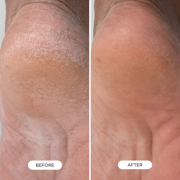 Before and after comparison of dry, rough heel skin showing visibly smoother and more hydrated results after using Foot Smooth.