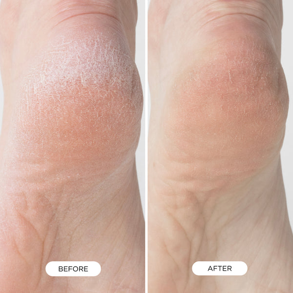 Before and after comparison of dry heel skin showing smoother, softer appearance after using Foot Smooth.